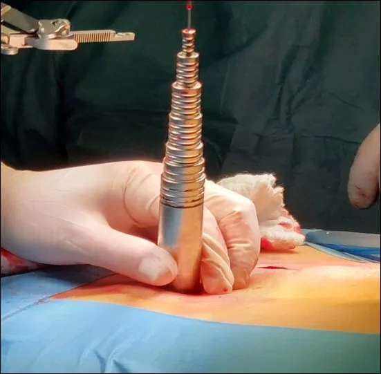 Descompresión Quirúrgica